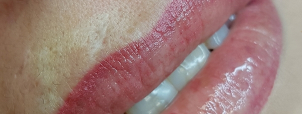 Mikorpigmentacja kamuflująca blizn