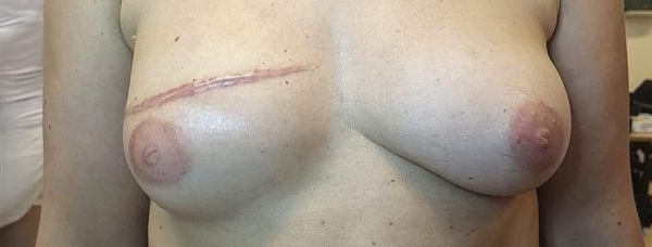 Pigmentacja brodawki sutkowej